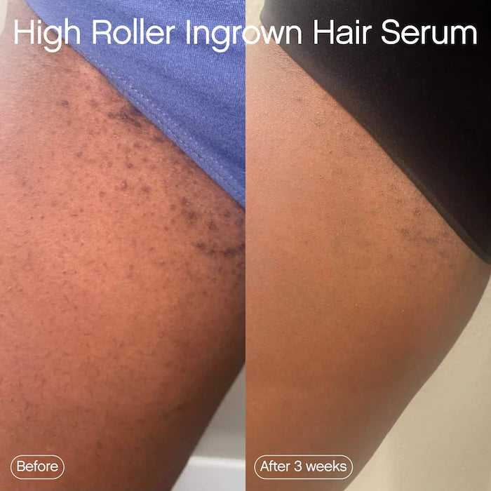 Topicals High Roller Ingrown Hair Tonic with AHA and BHA