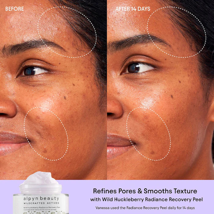 ALPYN Polishing Peel & Brightening Face Mask with 8 Acids & Huckleberry