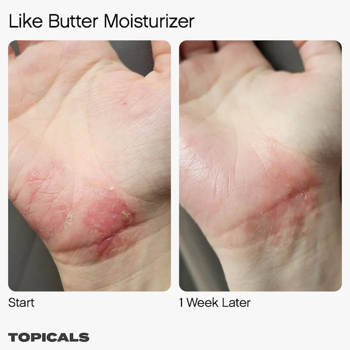 Topicals Like Butter Moisturizer for Dry, Sensitive & Eczema-Prone Skin