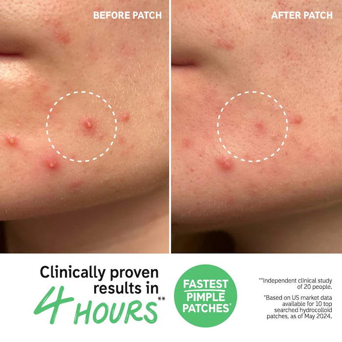 The INKEY List Hydrocolloid Invisible Pimple Patches + Salicylic Acid