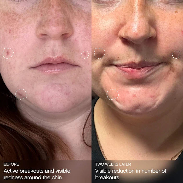 Topicals Clearly Clarifying & Calming Mask For Breakout-Prone Skin