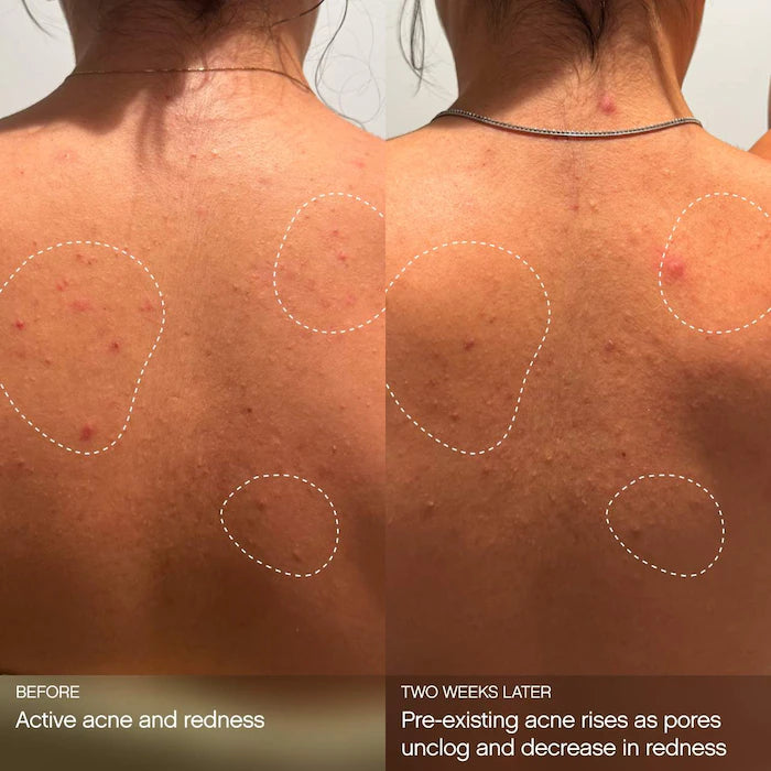 Topicals Clearly Clarifying & Calming Mist For Acne-Prone Skin