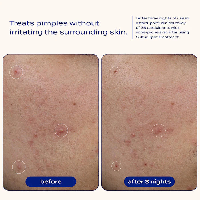 banu Sulfur Spot Treatment for Acne and Blemishes