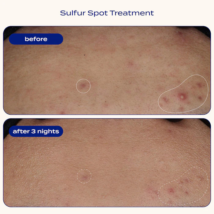 banu Sulfur Spot Treatment for Acne and Blemishes