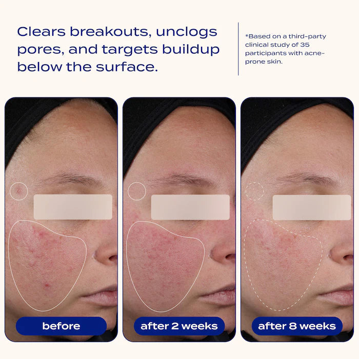 banu AHA + BHA Blemish Clearing and Exfoliating Serum with 2% Salicylic Acid