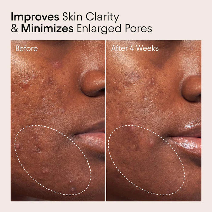 ALPYN  2% BHA Pore Perfecting Liquid Exfoliator for Brighter & Clearer Skin