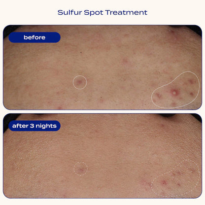 banu  Sulfur Spot Treatment for Acne and Blemishes
